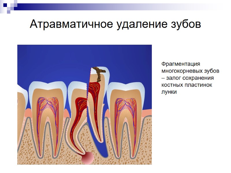 Атравматичное удаление зубов Фрагментация многокорневых зубов – залог сохранения костных пластинок лунки